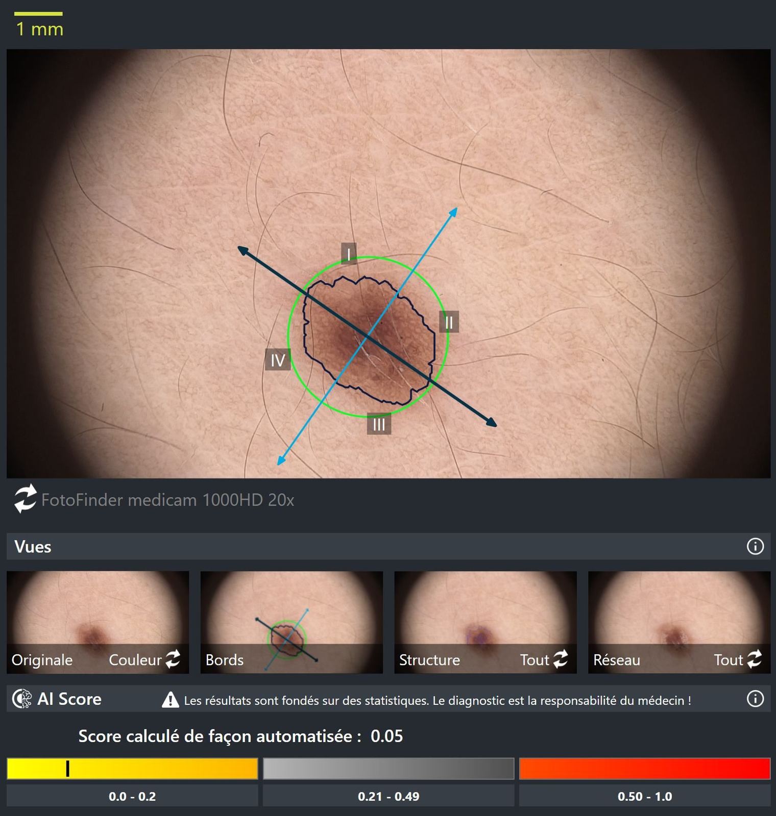 Dermoscopic analysis of a mole by the Fotofinder AI, with an automatic score.