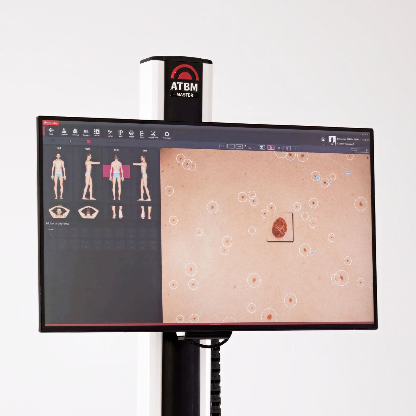 Fotofinder ATBM Master: 4K screen showing the body mapping and an analyzed lesion.
