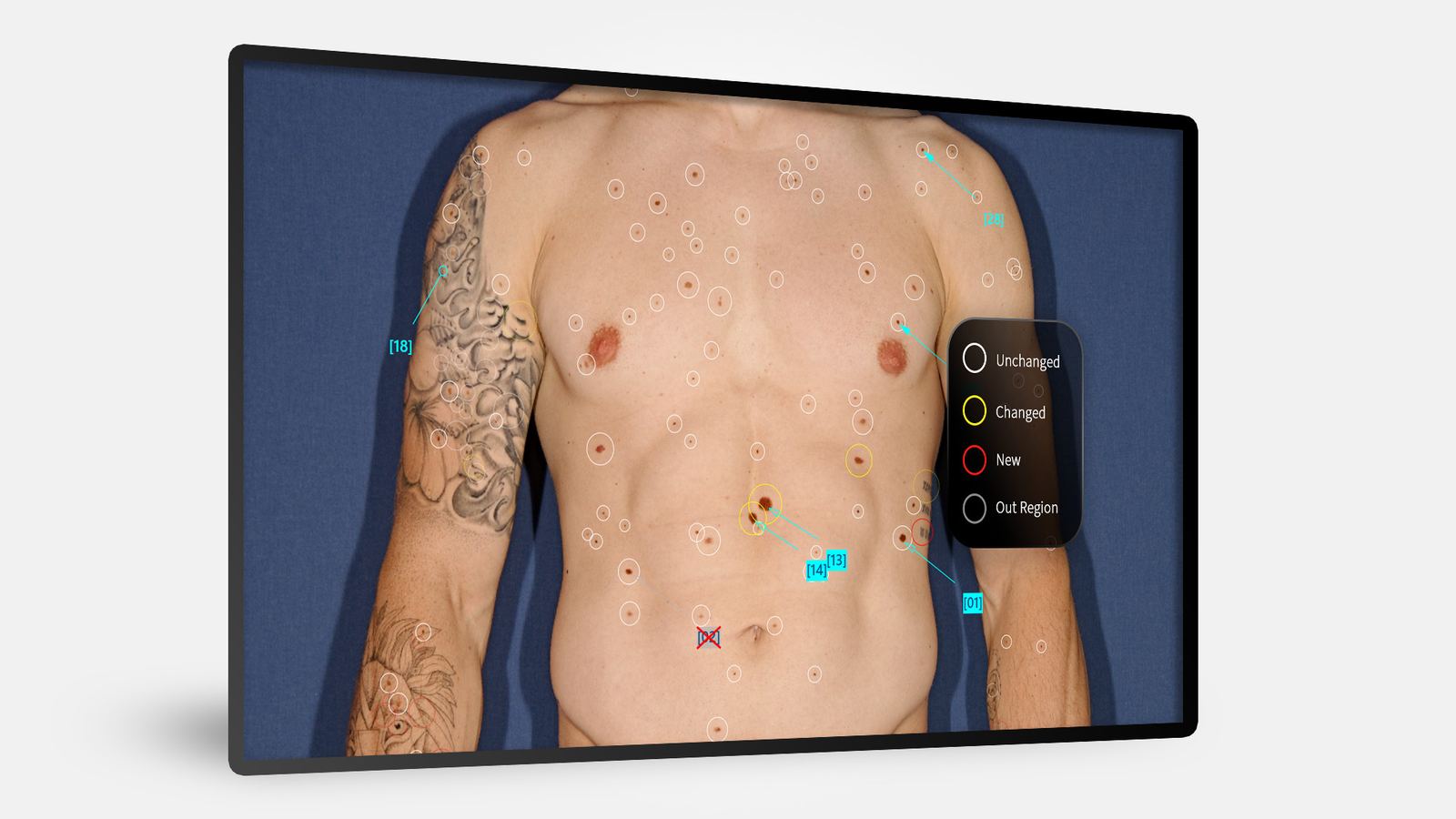 Fotofinder BodyScan: every mole identified and color-coded (unchanged / changed / new).