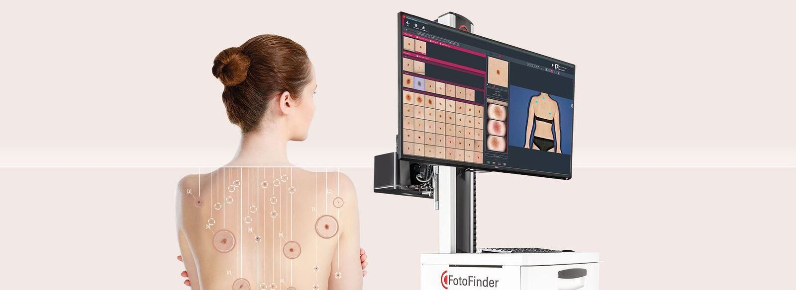 Fotofinder skin mapping: analyzed skin with numbered moles and Mosaic View gathering every mole on a single screen.