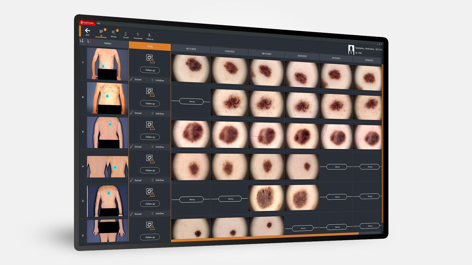 MoleGallery: a gallery of every mole analyzed in high-definition dermoscopy.