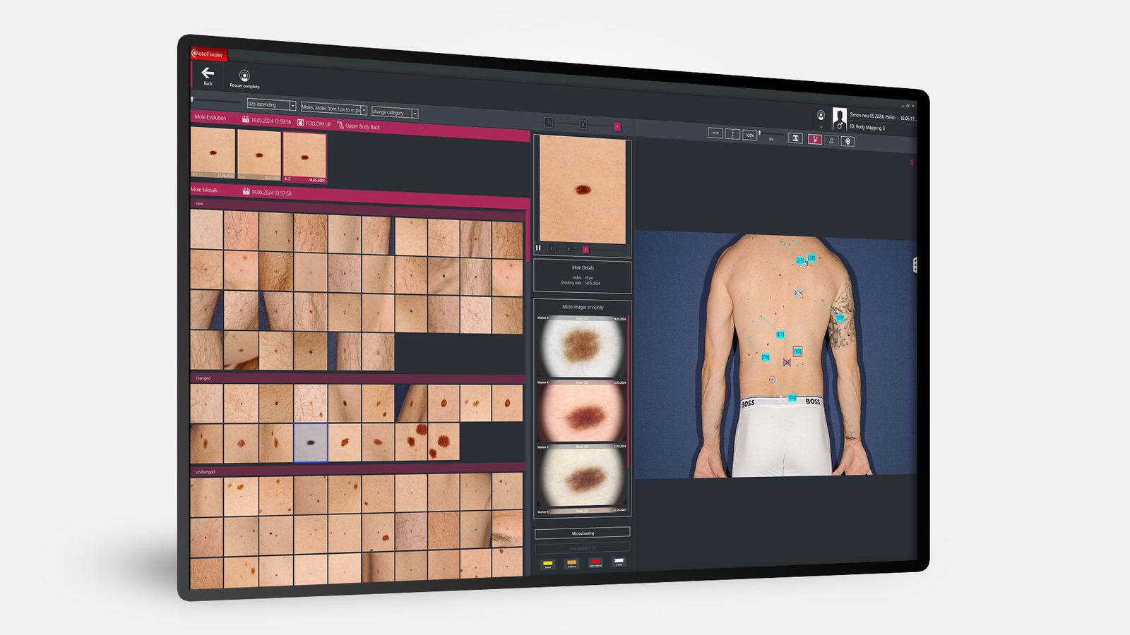 Fotofinder Universe software: Mosaic view gathering all of the patient's moles, sorted New / Changed / Unchanged.