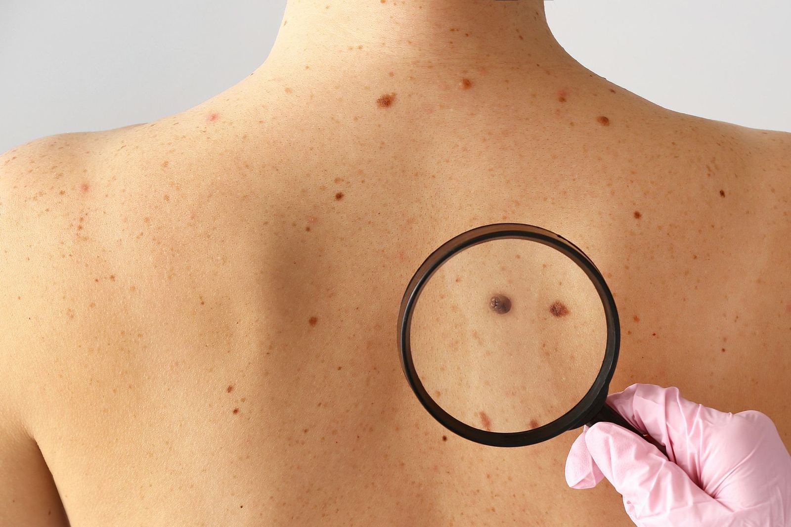 Naked-eye exam: a back with many moles examined with a magnifying glass.