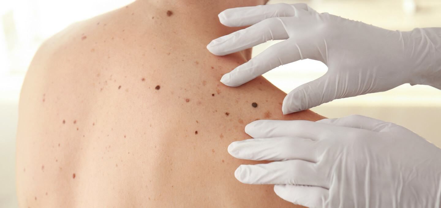 Clinical exam of skin with moles.