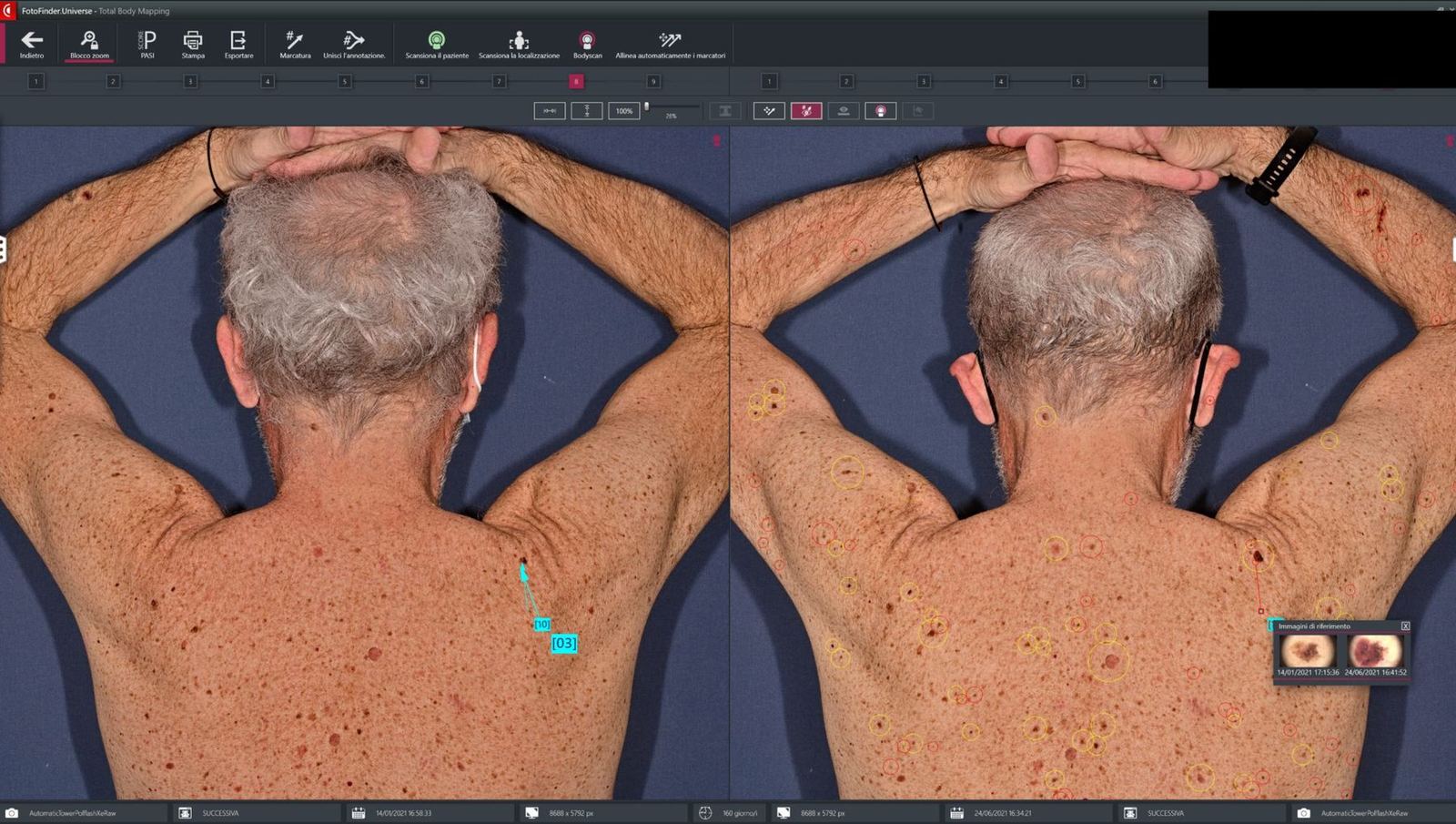 Automatic skin comparison across different dates in the Fotofinder Universe software.